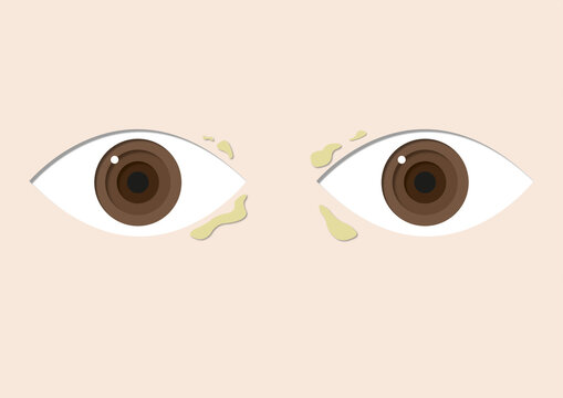Xanthelasma, illustration