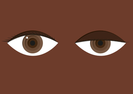Ptosis, illustration