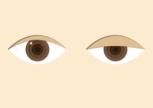 Horner's syndrome, illustration