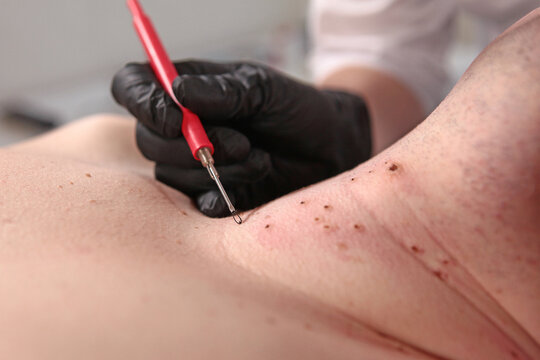 A cosmetologist removes a large number of papillomas on a man's neck. A cosmetologist removes a large number of papillomas on a man's neck. The concept of healthy skin. Close-up.