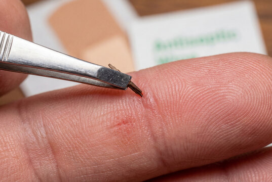 Removing wooden splinter from human finger using metal tweezers