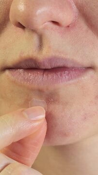 Vertical video of woman apply anti acne patch on face. Close up, 4k footage.