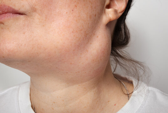 Woman with branchial cleft cyst. Close up. Large inflamed cyst scheduled to be removed surgically after failed draining and infection. Large cyst or lump on side of neck. Selective focus.