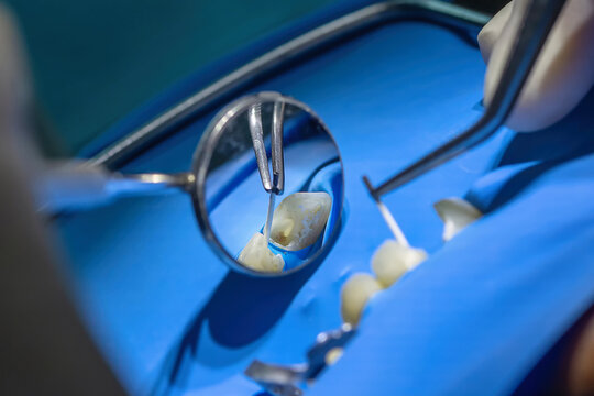 Close-up of root canal treatment under rubber dam isolation. Dentist cleaning and shaping infected canal using endodontic instruments in modern dental clinic.