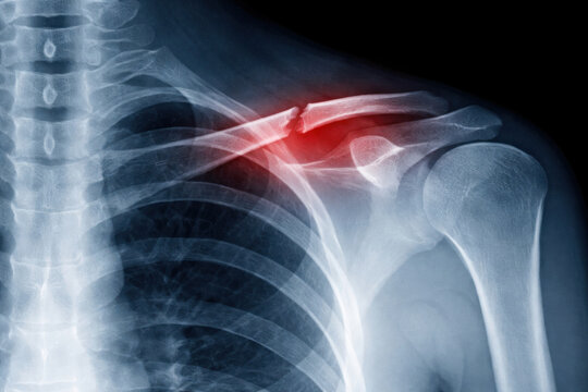 Shoulder X ray showing clavicle fracture with highlighted injury area. Medical imaging of bone trauma and orthopedic pathology.
