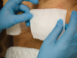 Nipple Reconstruction After a Cancerous Mastectomy, Majorca, Balearic Islands, Spain