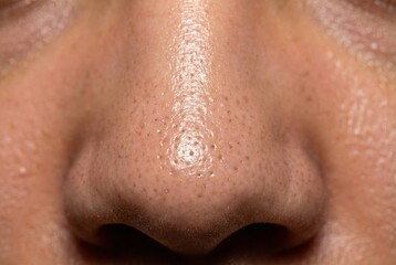 Naklejka premium Close-up of nose with sebaceous filaments and oily skin
