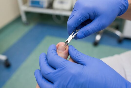 Podiatrist treating ingrown toenail with sterile nipper tool