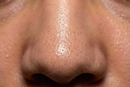 Close-up of nose with sebaceous filaments and oily skin