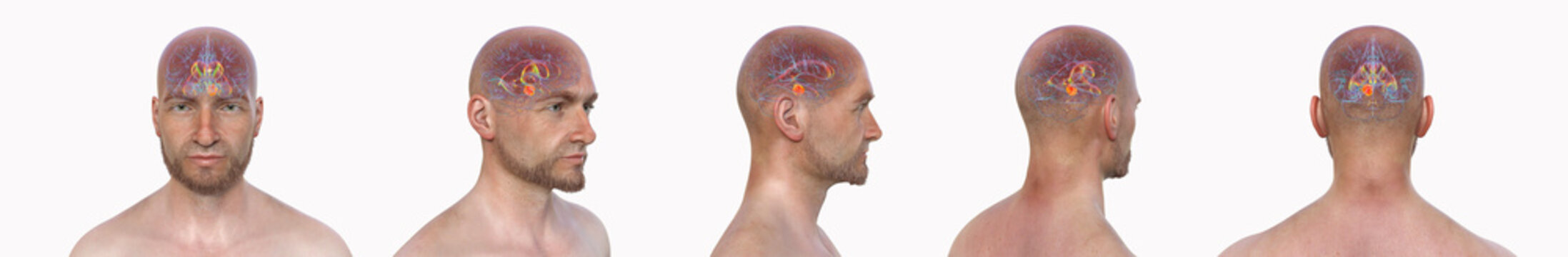 A brain tumor causing hydrocephalus, 3D illustration