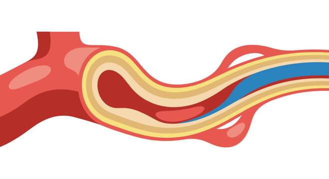 Angioplasty Procedure with Stent Placement in Blood Vessel.