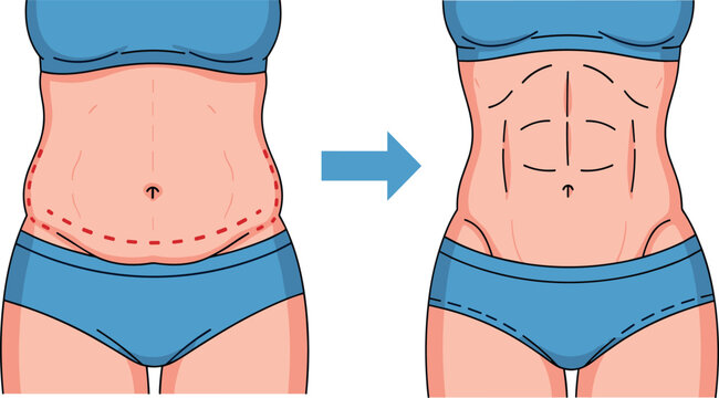 Belly fat removal and abdominal slimming before and after weight loss vector illustration