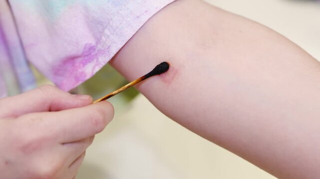 Using a cotton swab for treatment of ringworm infection on the arm