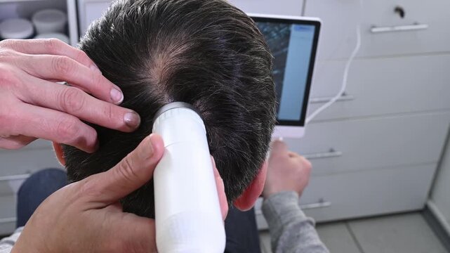 man looks at the results of a trichoscopy performed by a trichologist. Hair condition assessment, hair loss treatment, and dandruff treatment. male pattern baldness, alopecia