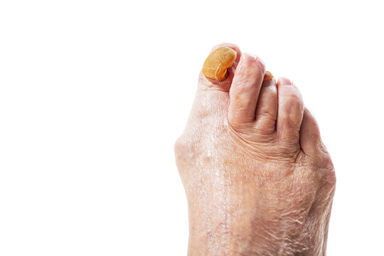 Old woman foot with onychogryphosis or ram horn nail disease. Medical condition, fungal infection concept for podiatry.