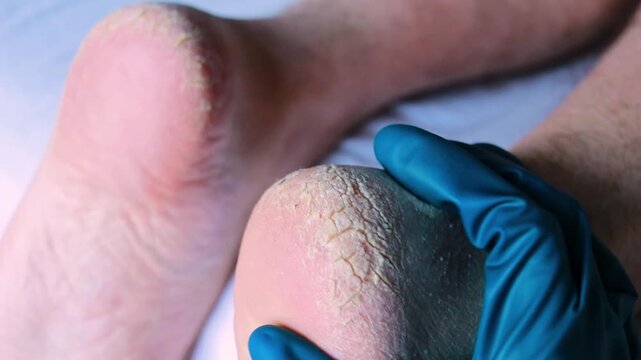Podiatrist doctor examining cracked heels of a man, foot fungus, dry foot and dry skin on feet, close up podology and dermatology treatment concept