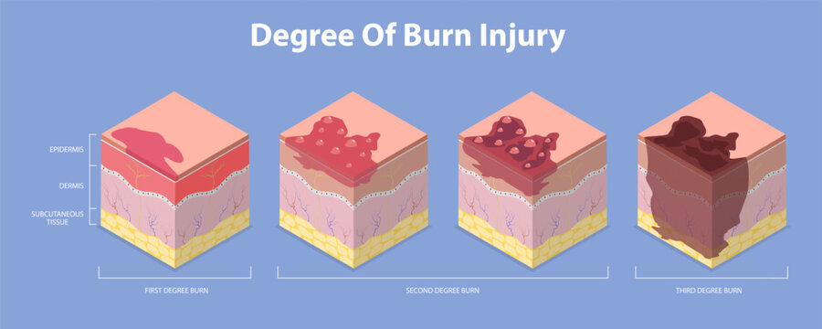 3D Isometric Flat Vector Illustration of Skin Burn Degree, Stages In Epidermis And Dermis Layers
