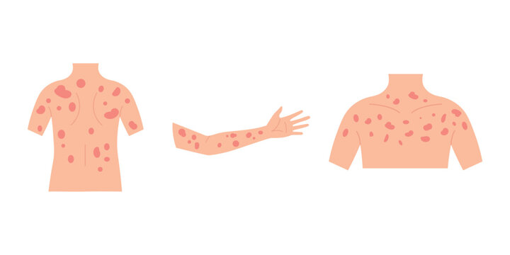Measles Virus Skin Symptoms Medical Illustration with Red Skin Rash on Torso and Arm.