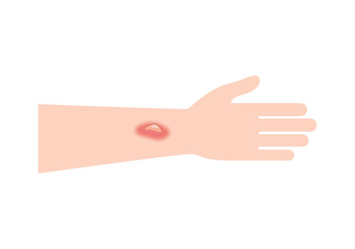 Itchy Mosquito Bite on Arm Skin. Insect Bite Skin Irritation Concept.