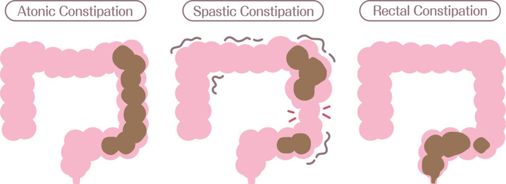 Types of Constipation Diagram Showing Atonic Spastic and Rectal Constipation