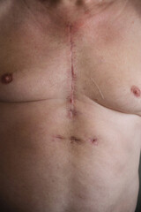 Naklejka premium scar on a man's chest after heart surgery