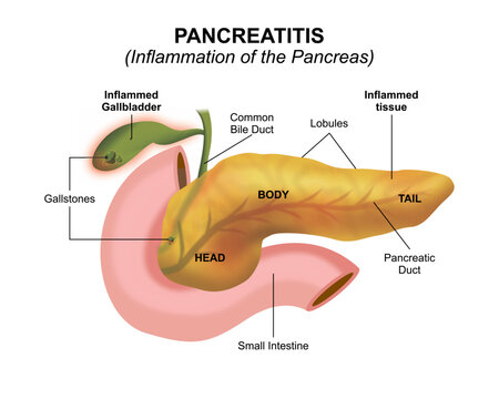 Pancreatitis (Inflammation of the Pancreas)