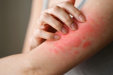 Woman Scratching Irritated Skin - Close-up of Eczema or Rash