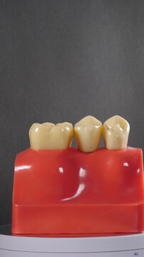  Dental implant crown demonstration by dentist. Rotating jaw model of human teeth with implants. Vertical footage. Grey background. Missing teeth replacement. Dental implant installation. 4 k video