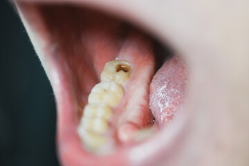 奥歯が欠けて虫歯になっている口を開けた男性