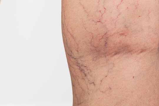 Close up of spider veins on female thigh, varicose vascular network and skin condition