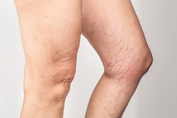 Spider veins and varicose capillary network on female legs, vascular problem close up