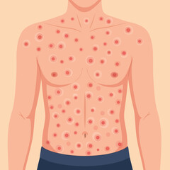 Widespread Skin Lesions and Bumps on Torso