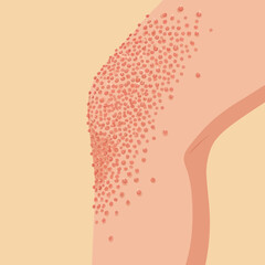 Keratosis Pilaris Skin Condition Illustration