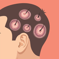 Hair Follicle Infection and Scalp Dermatitis