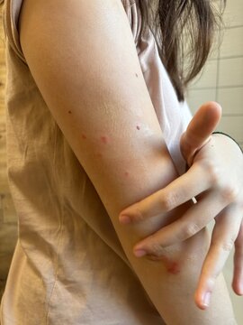 psoriasis on the body of a teenage girl