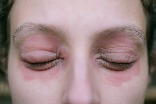 Close-Up of a Woman&rsquo;s Eyes Shut, Showing Eczema Around the Eyelids