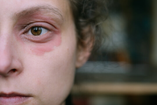 Close-Up of a Woman's Face with Eczema