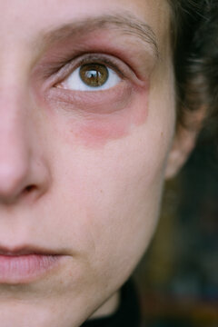Partial Face of a Woman with Eczema Around Her Eye