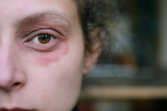 Partial Face of a Woman with Eczema Around Her Eye