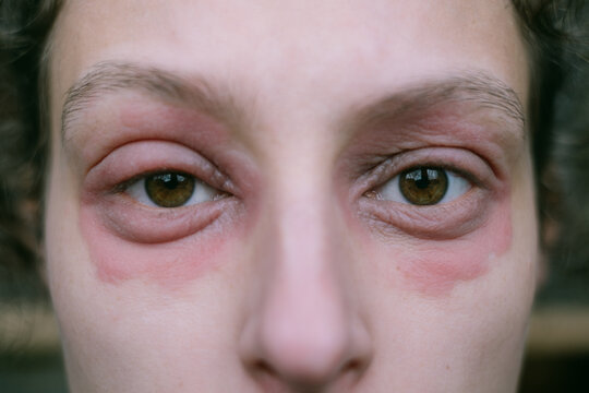 Woman Looking Directly at the Camera with Eczema Around Her Eyes