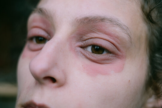 Close-Up of a Woman&rsquo;s Eyes with Eczema and Irritation around her Eyes