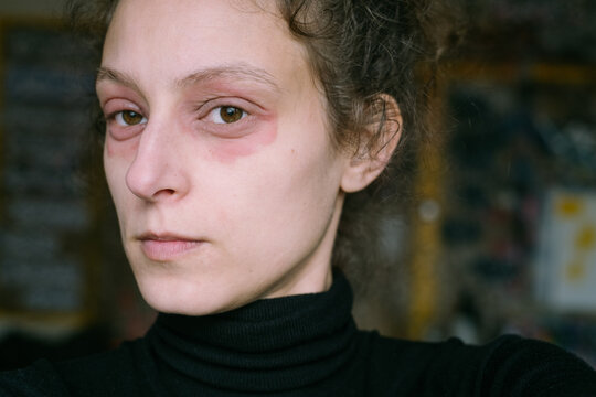 Woman with Red Irritated Skin Around Eyes