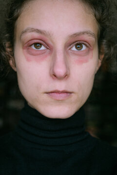 Woman with Eczema Around Eyes