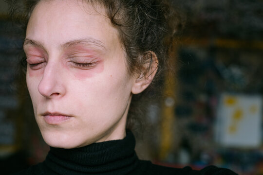 Woman with Red Irritated Skin Around Eyes