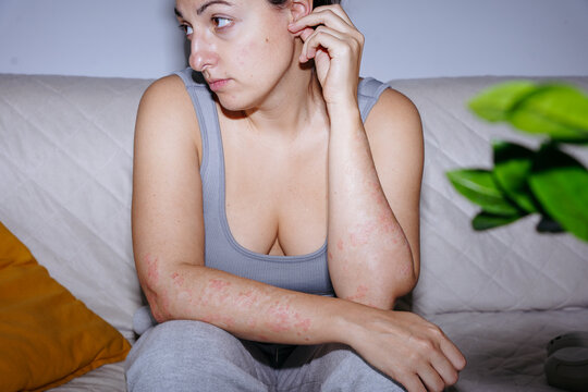 Woman with psoriasis