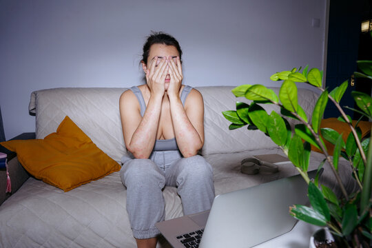 Woman with psoriasis