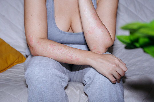 Woman with psoriasis