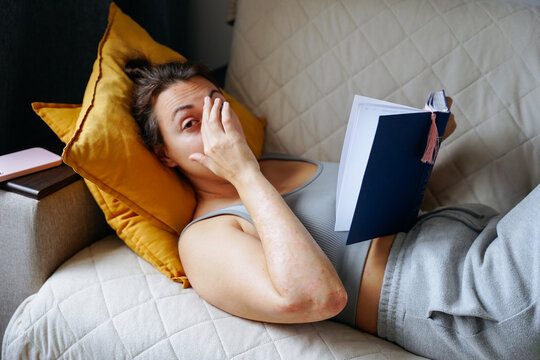Woman with psoriasis