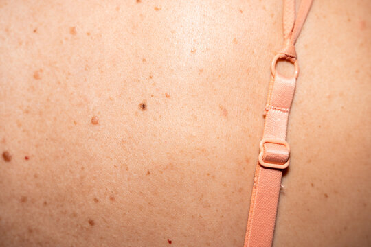 Freckled Skin with lingerie Strap