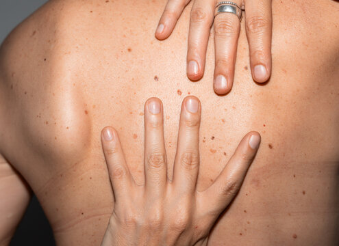 Woman Hands Touching Skin With Freckles and Beauty Marks